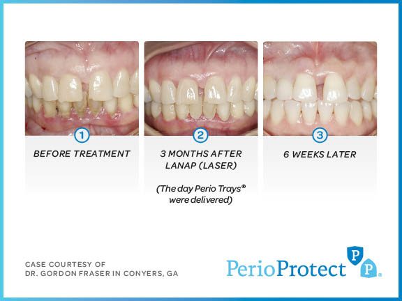 perio protect gum disease treatment at cary dental in sherwood and canby